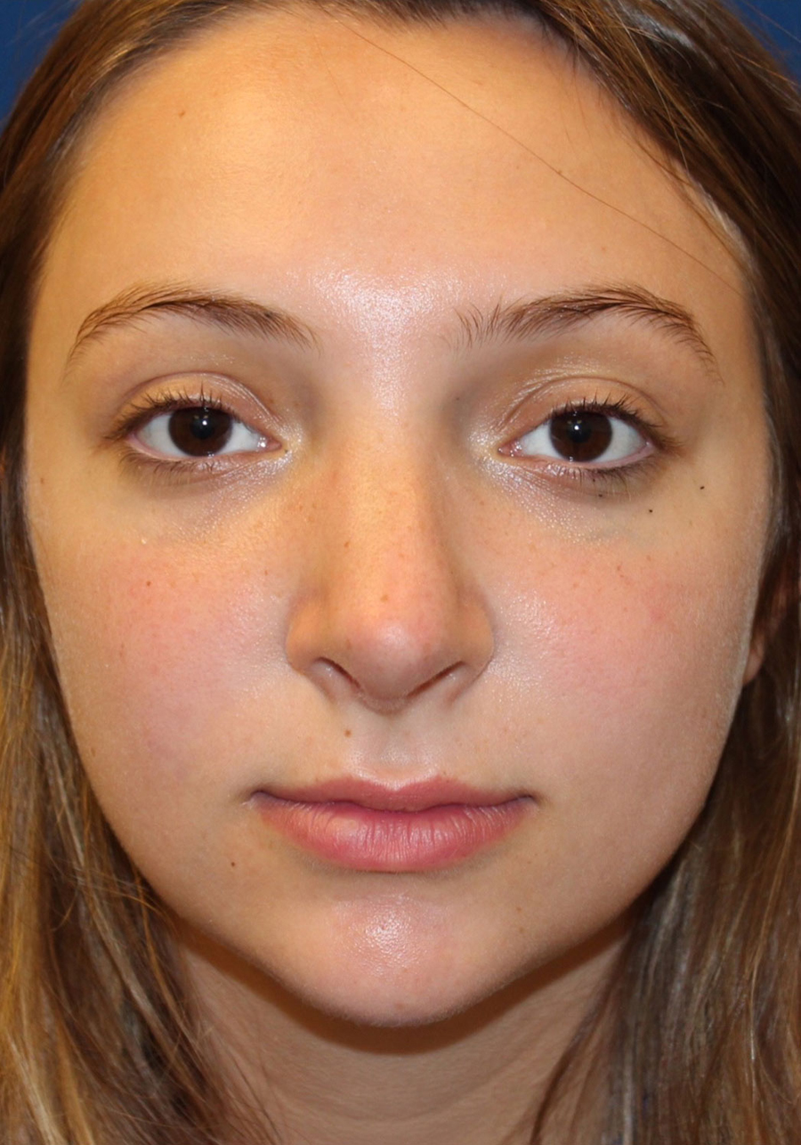 Female Cosmetic Rhinoplasty