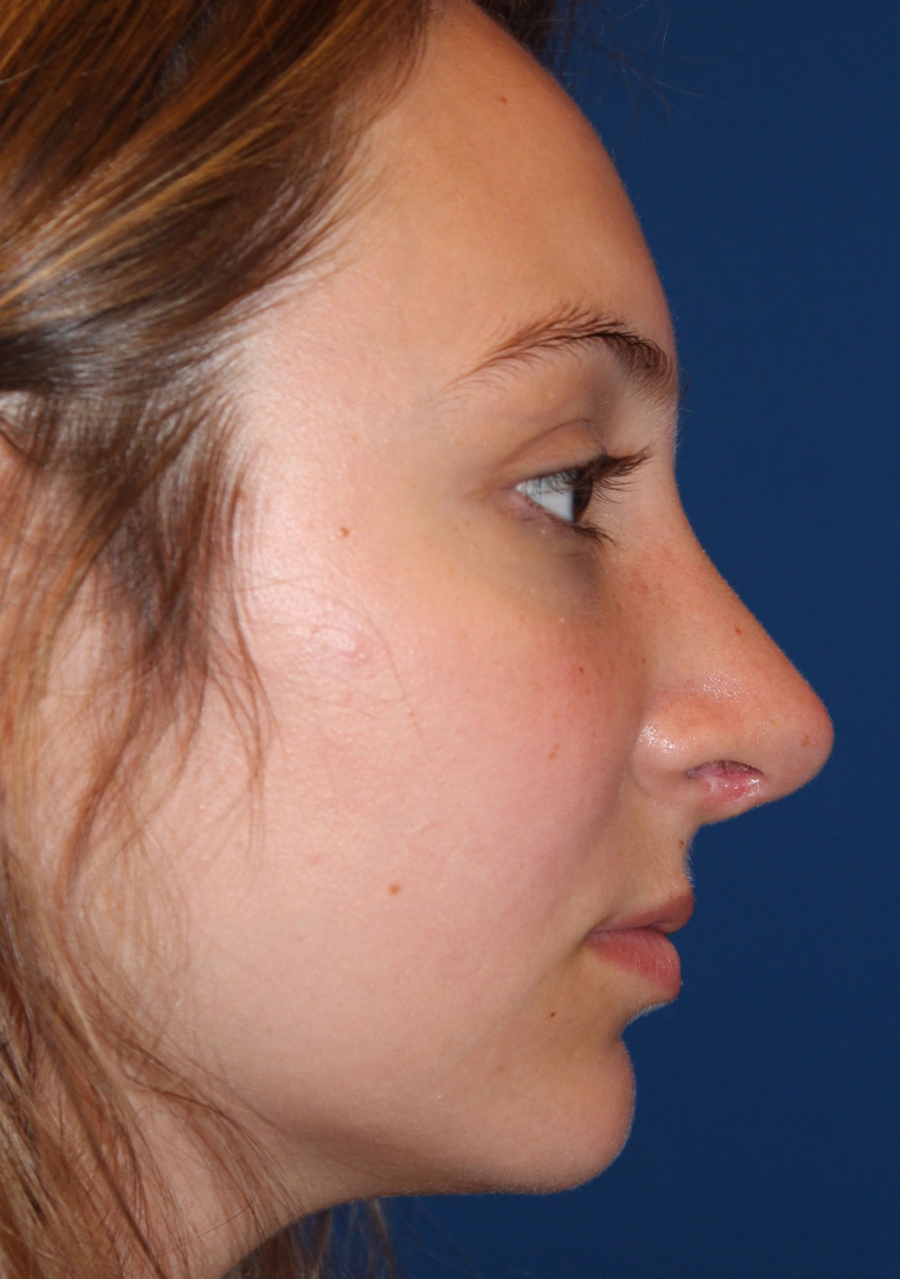 Female Cosmetic Rhinoplasty