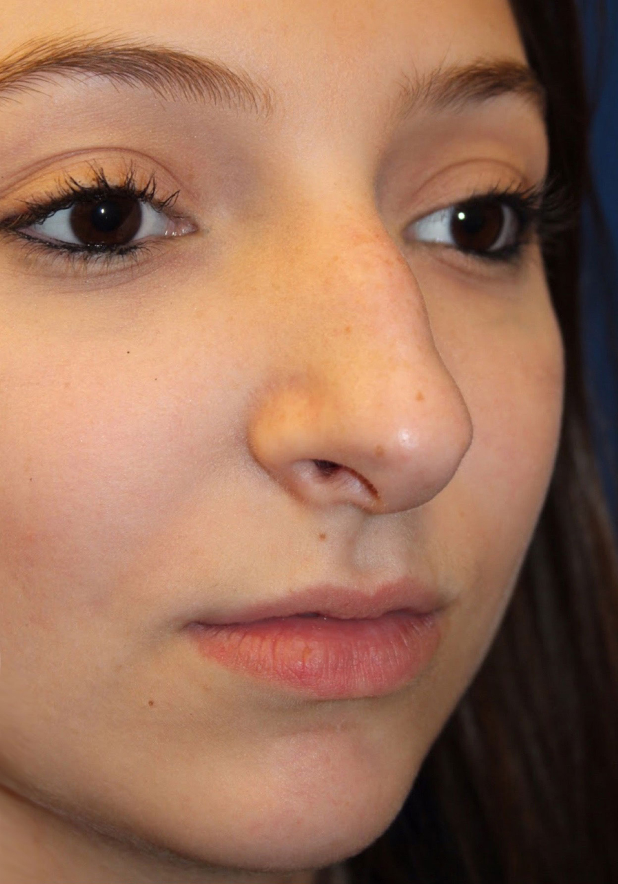 Female Cosmetic Rhinoplasty