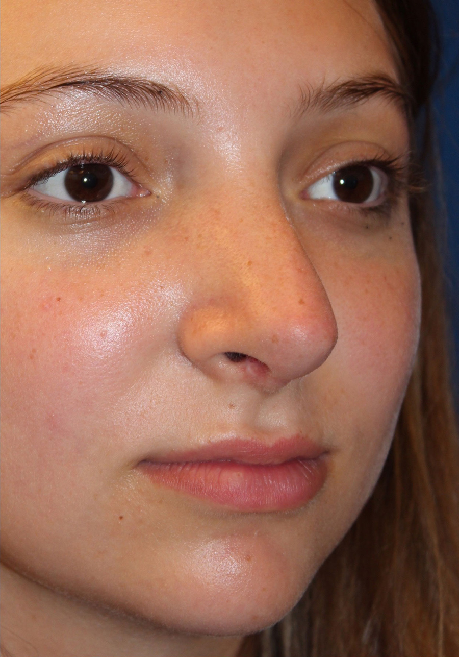 Female Cosmetic Rhinoplasty