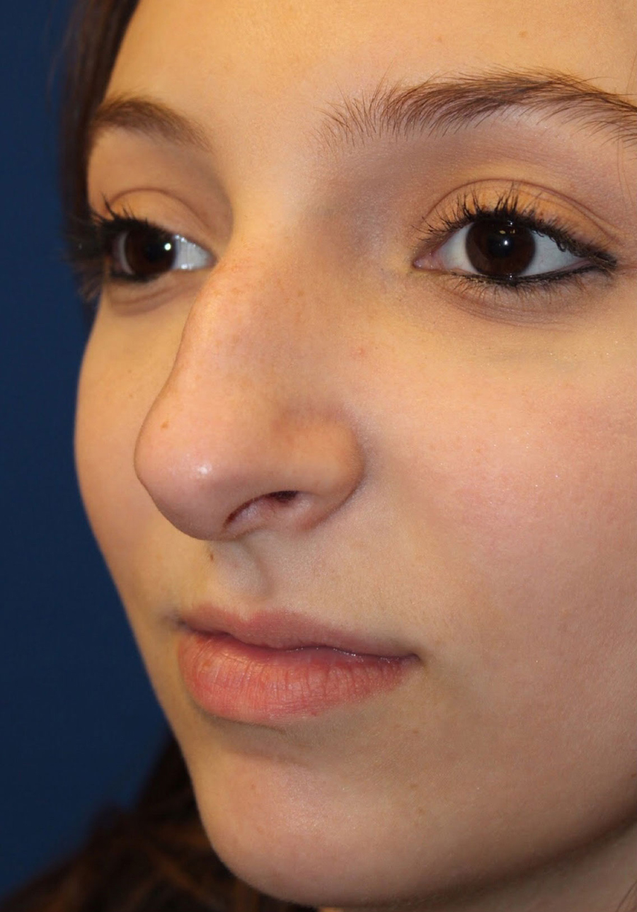 Female Cosmetic Rhinoplasty