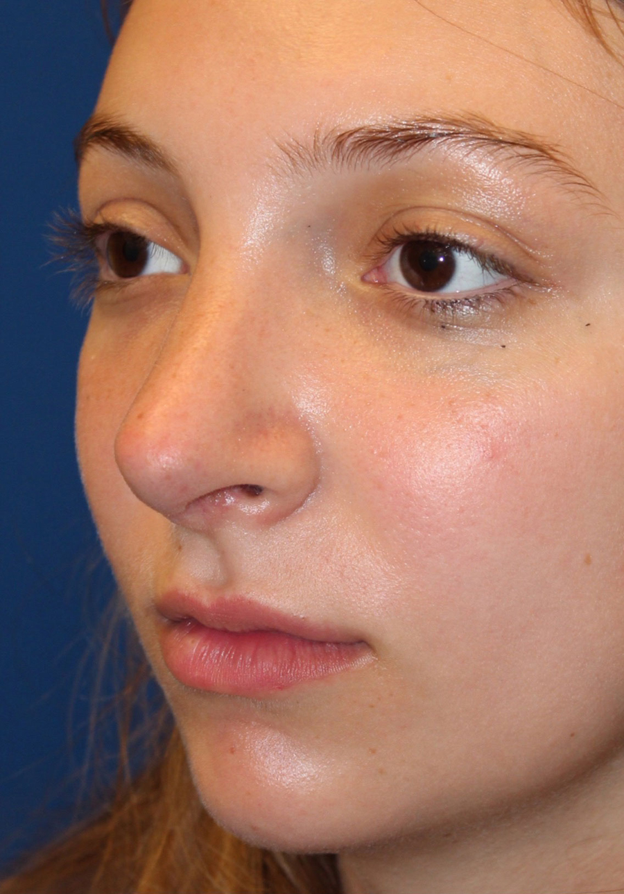 Female Cosmetic Rhinoplasty