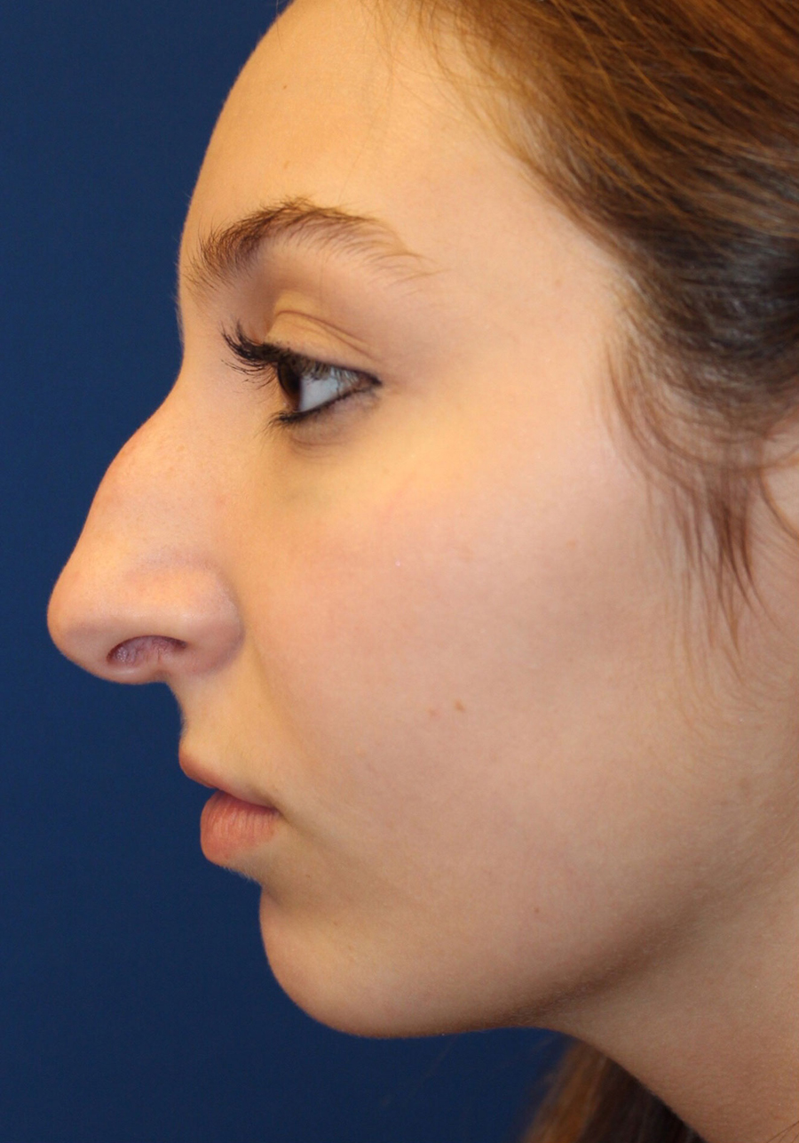 Female Cosmetic Rhinoplasty