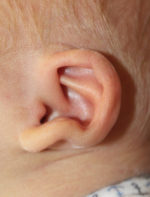 Ear Reshaping