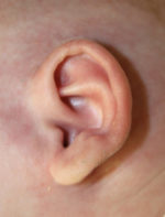 Ear Reshaping