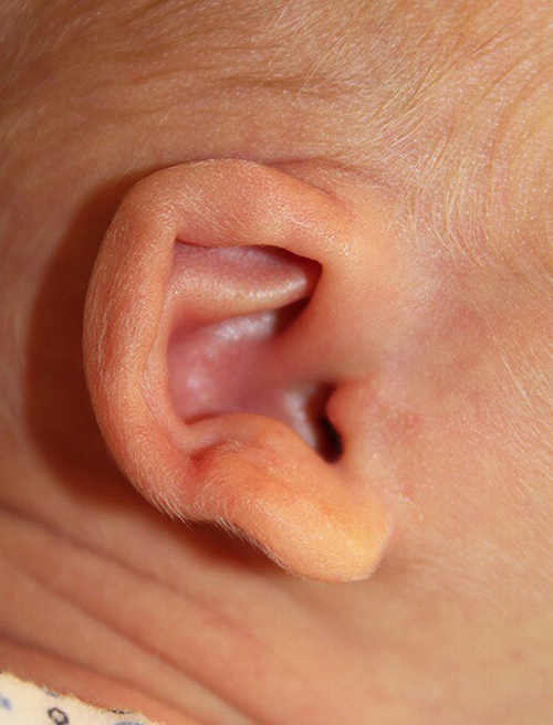 Ear Reshaping