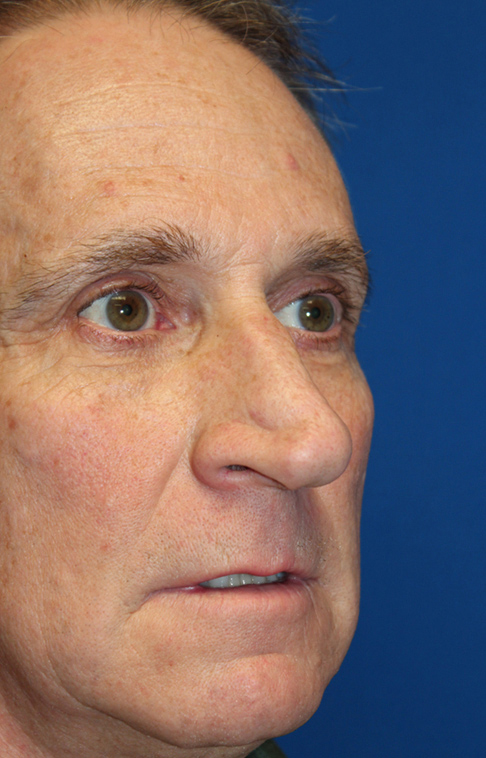 Male Cosmetic Rhinoplasty