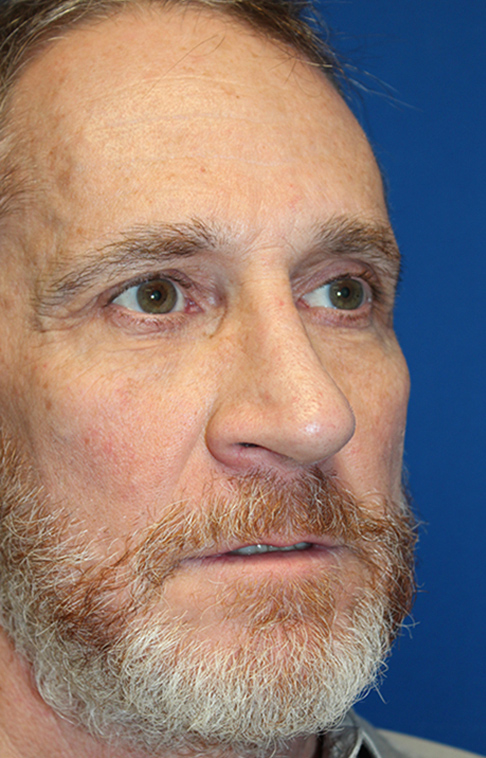 Male Cosmetic Rhinoplasty