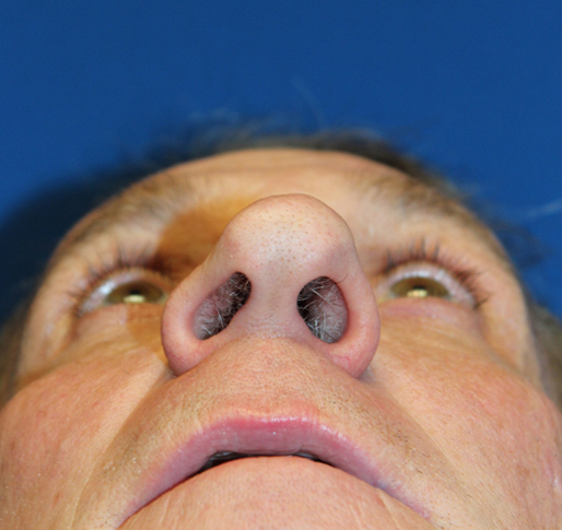 Male Cosmetic Rhinoplasty