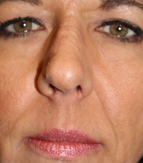 Female Cosmetic Rhinoplasty