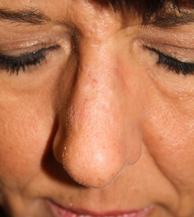 Female Cosmetic Rhinoplasty