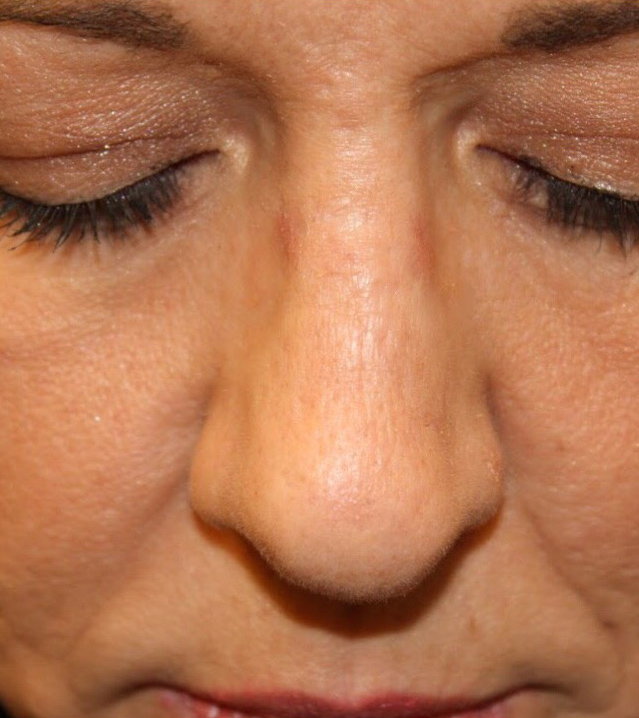 Female Cosmetic Rhinoplasty