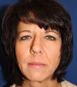 Female Cosmetic Rhinoplasty