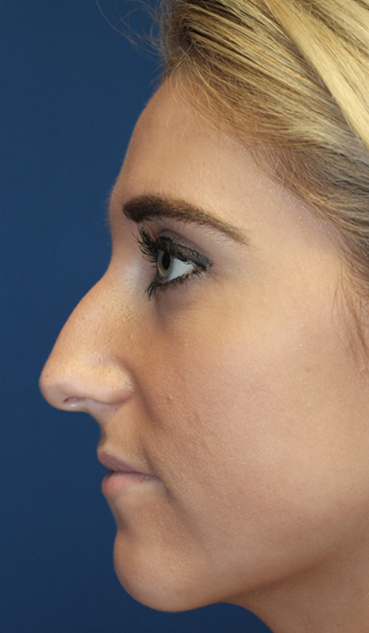 Female Cosmetic Rhinoplasty