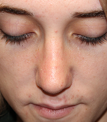 Female Cosmetic Rhinoplasty