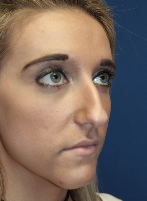 Female Cosmetic Rhinoplasty