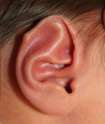 Ear Reshaping