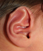 Ear Reshaping