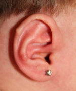 Ear Reshaping