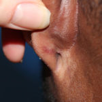 Keloid