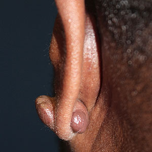 Keloid