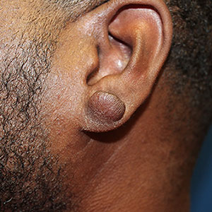 Keloid