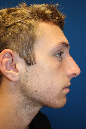 Male Cosmetic Rhinoplasty