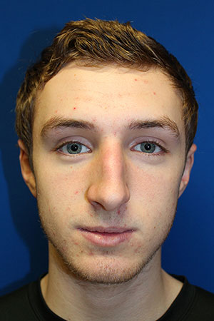 Male Cosmetic Rhinoplasty