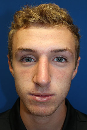 Male Cosmetic Rhinoplasty