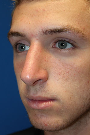 Male Cosmetic Rhinoplasty