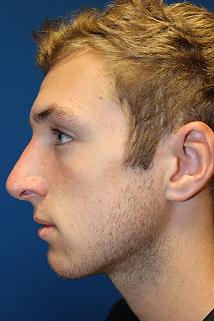 Male Cosmetic Rhinoplasty