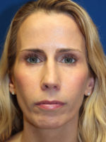 Female Cosmetic Rhinoplasty