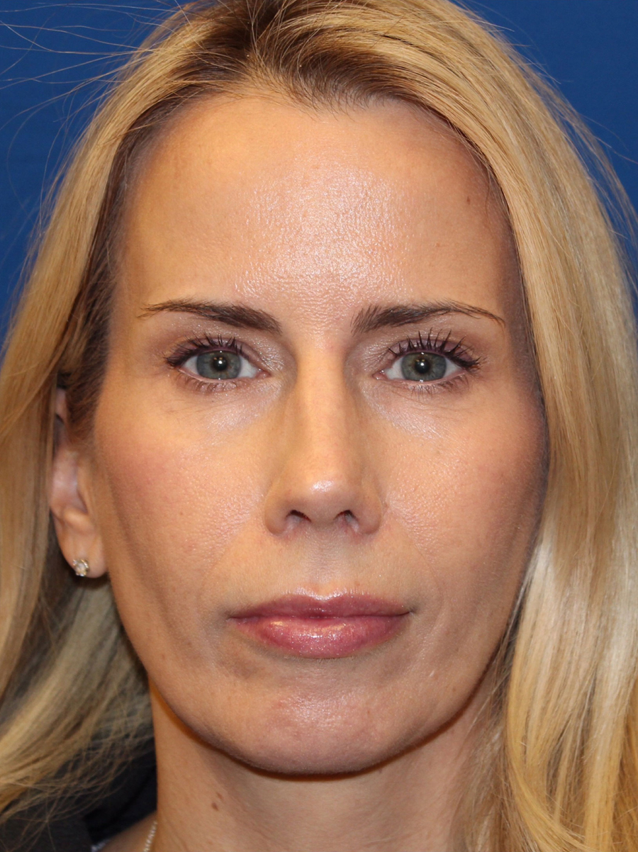 Female Cosmetic Rhinoplasty