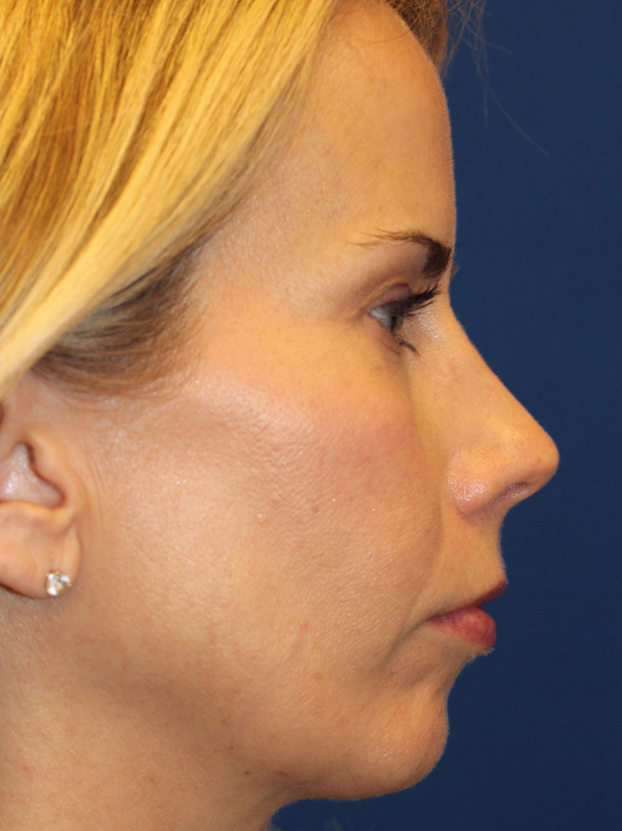 Female Cosmetic Rhinoplasty