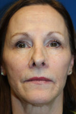 Female Revision Rhinoplasty