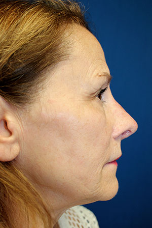 Female Revision Rhinoplasty