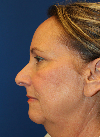 Female Cosmetic Rhinoplasty