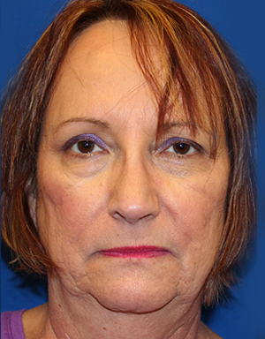 Female Cosmetic Rhinoplasty