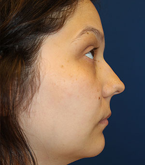 Female Revision Rhinoplasty