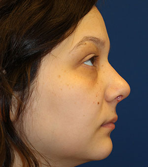 Female Revision Rhinoplasty