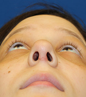 Female Revision Rhinoplasty