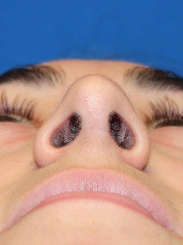 Female Cosmetic Rhinoplasty