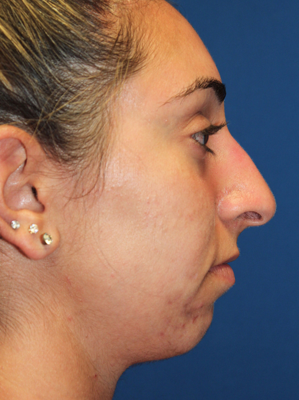 Female Cosmetic Rhinoplasty