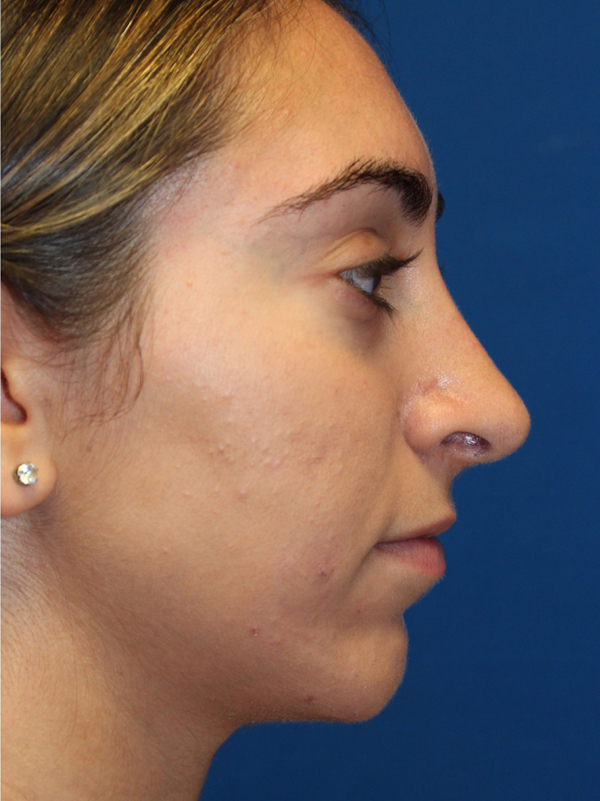 Female Cosmetic Rhinoplasty