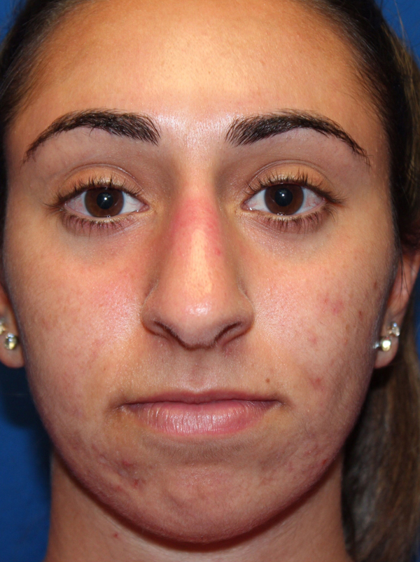 Female Cosmetic Rhinoplasty