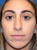 Female Cosmetic Rhinoplasty