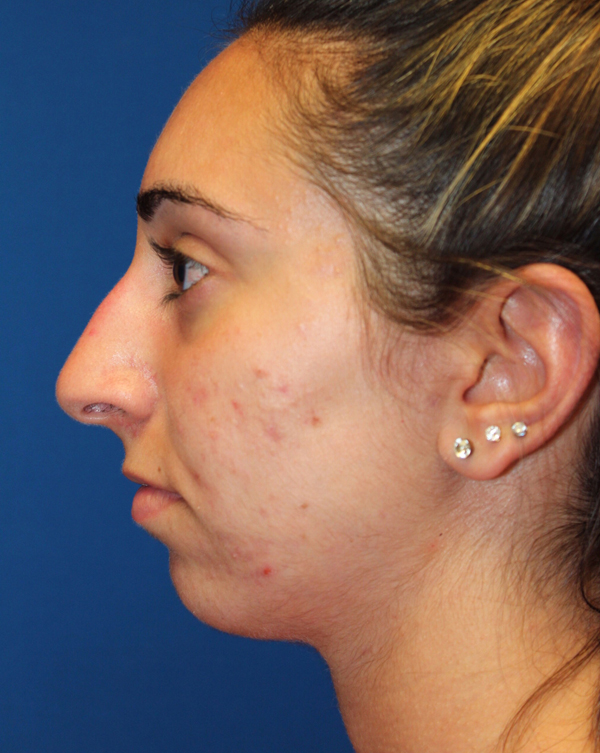 Female Cosmetic Rhinoplasty