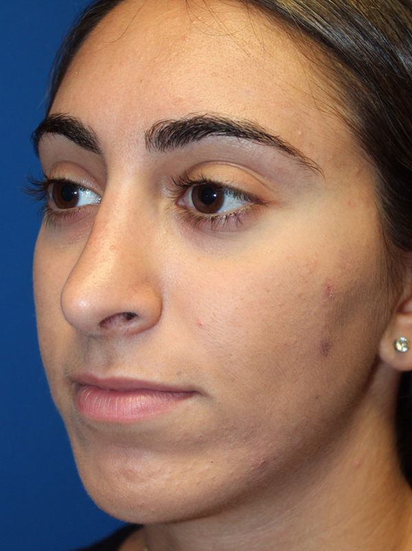 Female Cosmetic Rhinoplasty