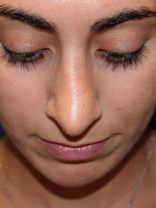 Female Cosmetic Rhinoplasty