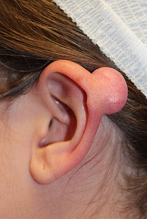 Keloid